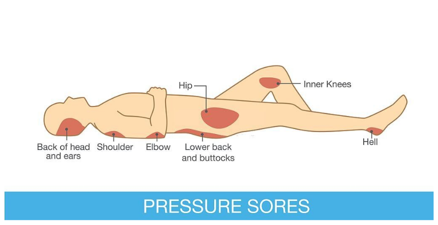 pressure ulcers prevention