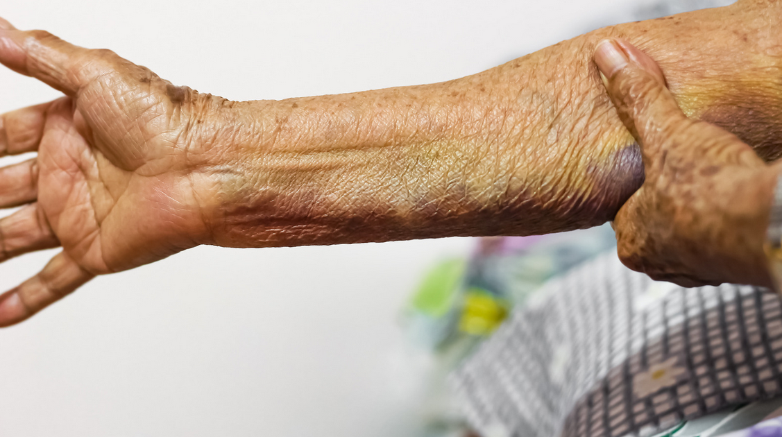 elderly-skin-bruising.png